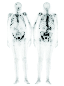 bone scan